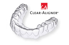 clear aligner